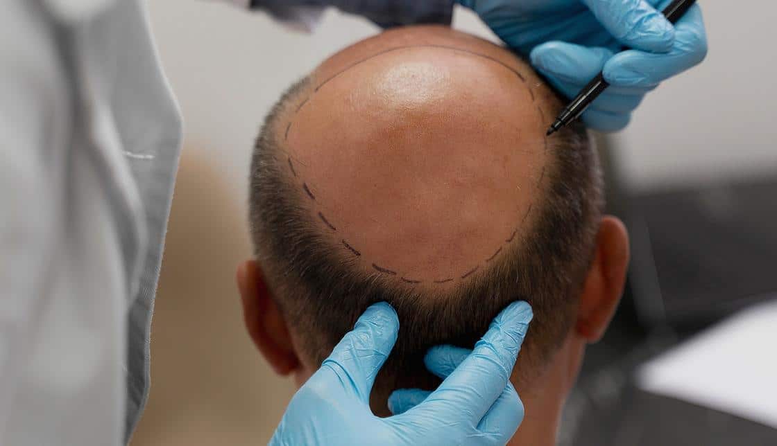 hairloss-section3-image