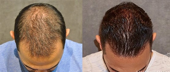 before and after male hair transplant