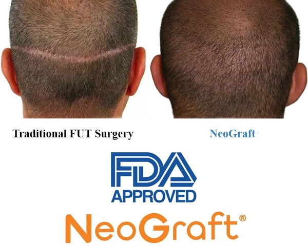 burbank hair transplant neo graft FDA approved