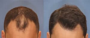 before and after men's hair restoration
