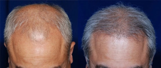 before and after elderly male hair transplant