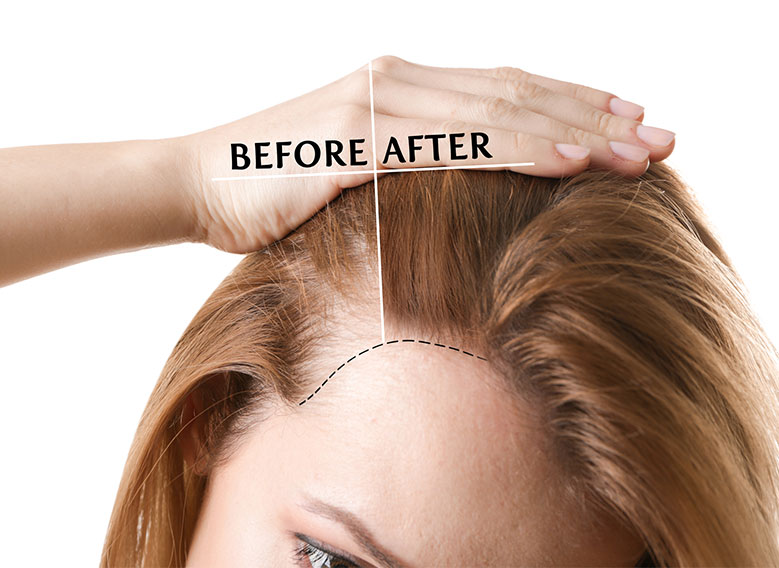 Woman before and after hair loss treatment on white background